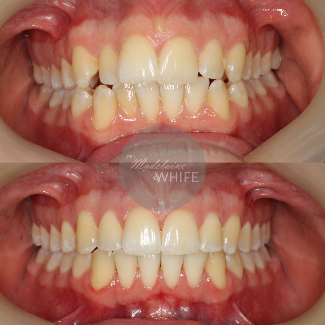 Patient 3 transformation